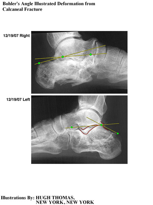 Bohlers-Angle-Illustrated-Deformation-from-Calcaneal-Fracture