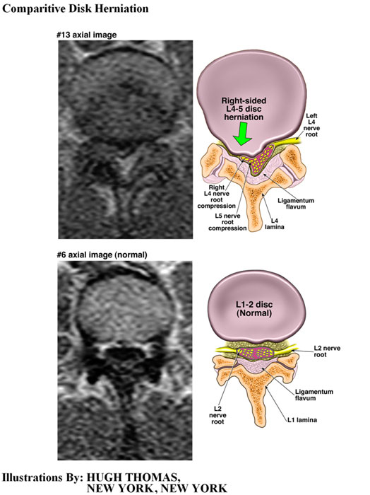 Comparitive-Disk-Hermoatopm