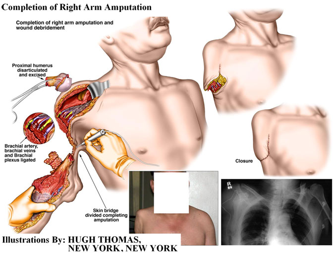 Completion-of-Right-Arm-Amputation