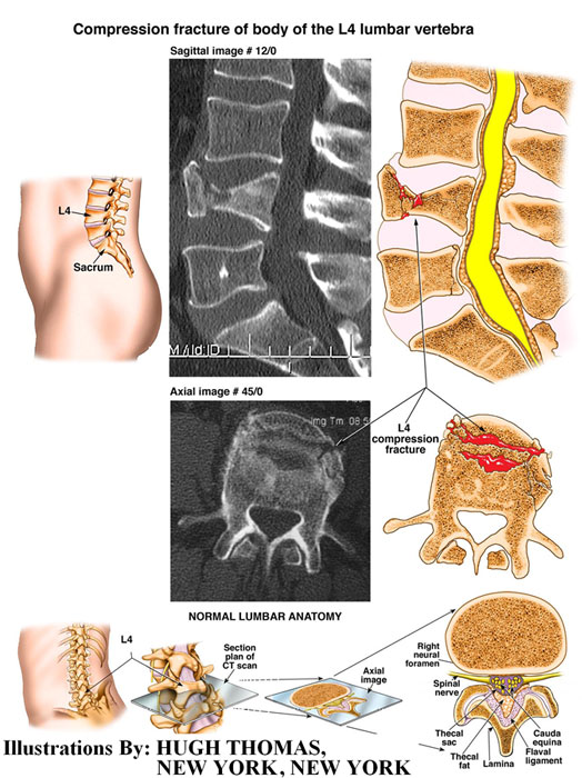 Compression-Fracture-of-body-of-the-L4-Lumbar-Vertebra