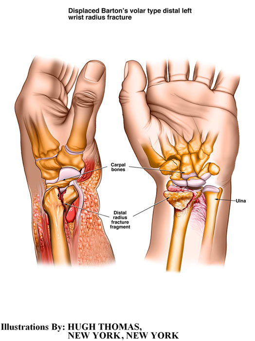 Displaced-Barton’s-solar-type-distal-left-wrist-radius-fracture