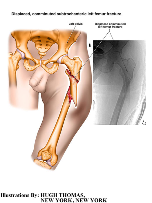 Displaced-comminuted-subtrochateric-left-femur-fracture