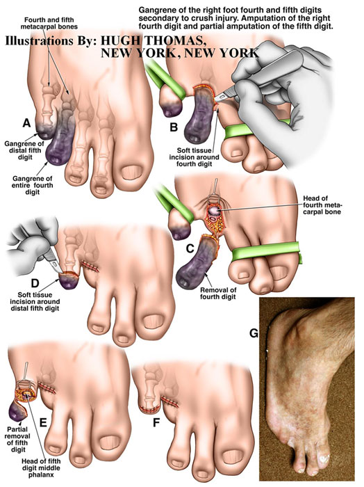 Gangrene-of-the-right-foot-fourth-and-fifth-digits-secondary-to-crush-injury