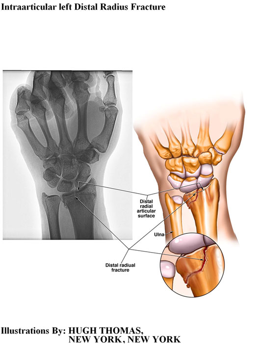 Intraarticular-left-Distal-Radius-Fracture