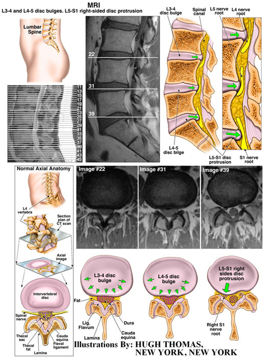 L3-4-and-L4-5-bulges.-L5-S1-right-sided-disc-protrusion