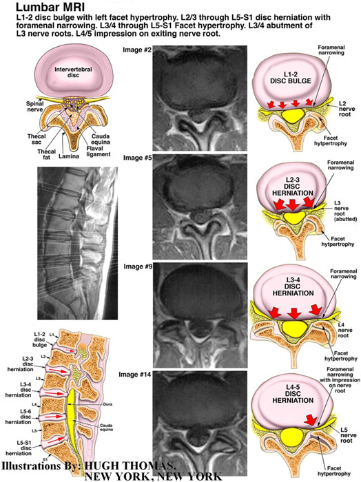 Lumbar-MRI-L1-2-disc-bulge-with-left-facet-hypertrophy