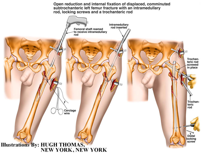 Open-reduction-and-internal-fixation-of-displacement-1Open-reduction-and-internal-fixation-of-displacement