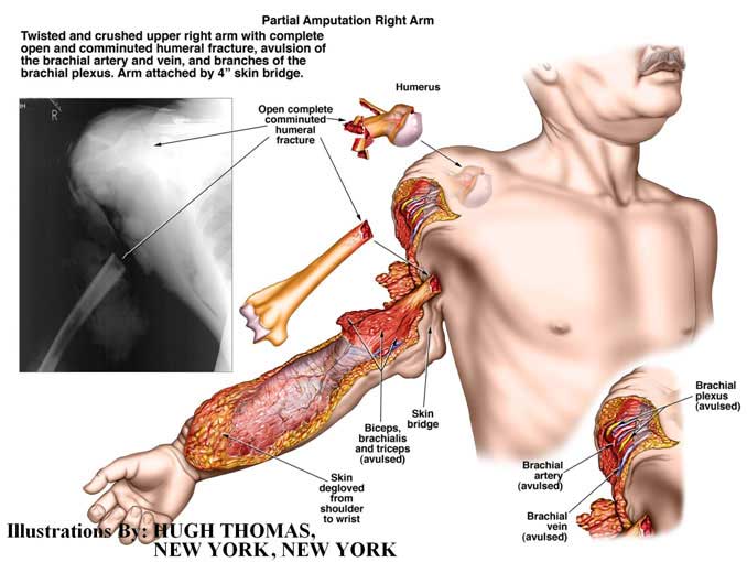 Partial-Amputation-Right-Arm