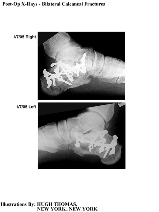Post-Op-X-Rays-Bilateral-Calcaneal-Fractures