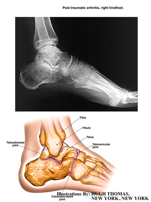 Post-traumatic-arthritis-right-hindfoot