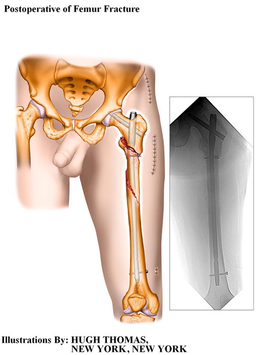 Postoperative-of-Femur-Fracture