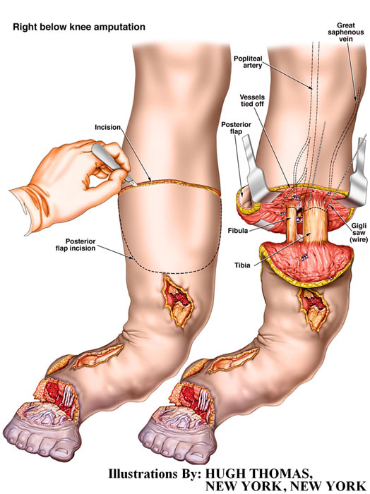 Right-Below-Knee-Amputation