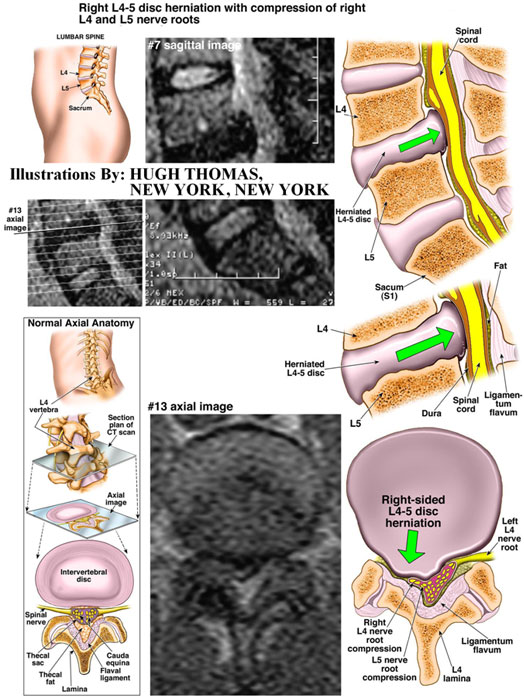 Right-L4-5-disc-herniation-with-compression-of-right-L4-and-L5-nerve-roots