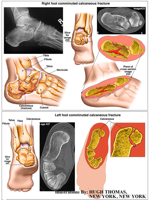Right-foot-comminuted-calcaneous-fracture