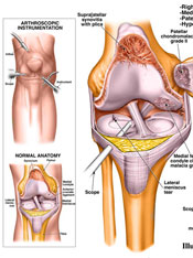 Right knee lateral meniscus tear