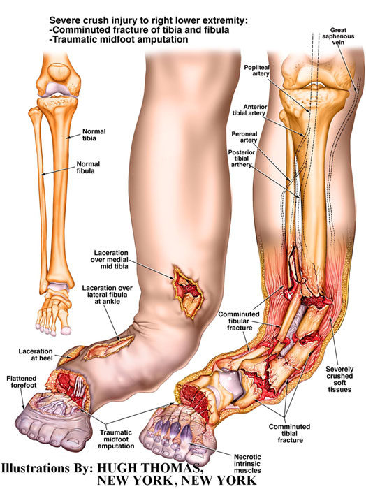 Severe-crush-injury-to-right-lower-extremity-1