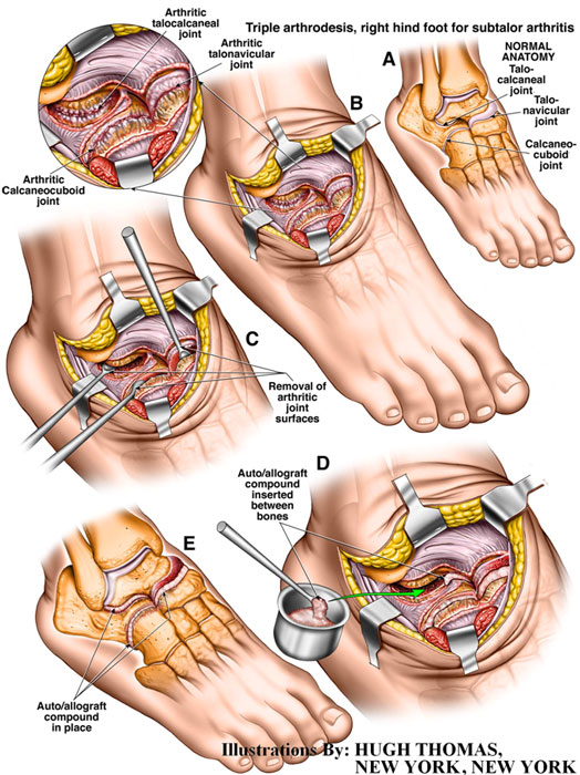 Triple-arthrodesis-right-hind-foot-for-subtalor-arthritis