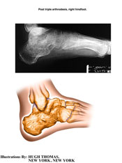 Post triple arthrodesis, right hindfoot